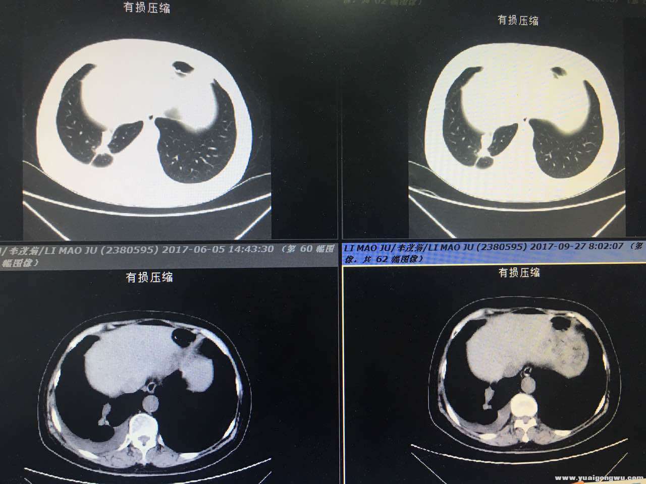 6月、9月对比CT图