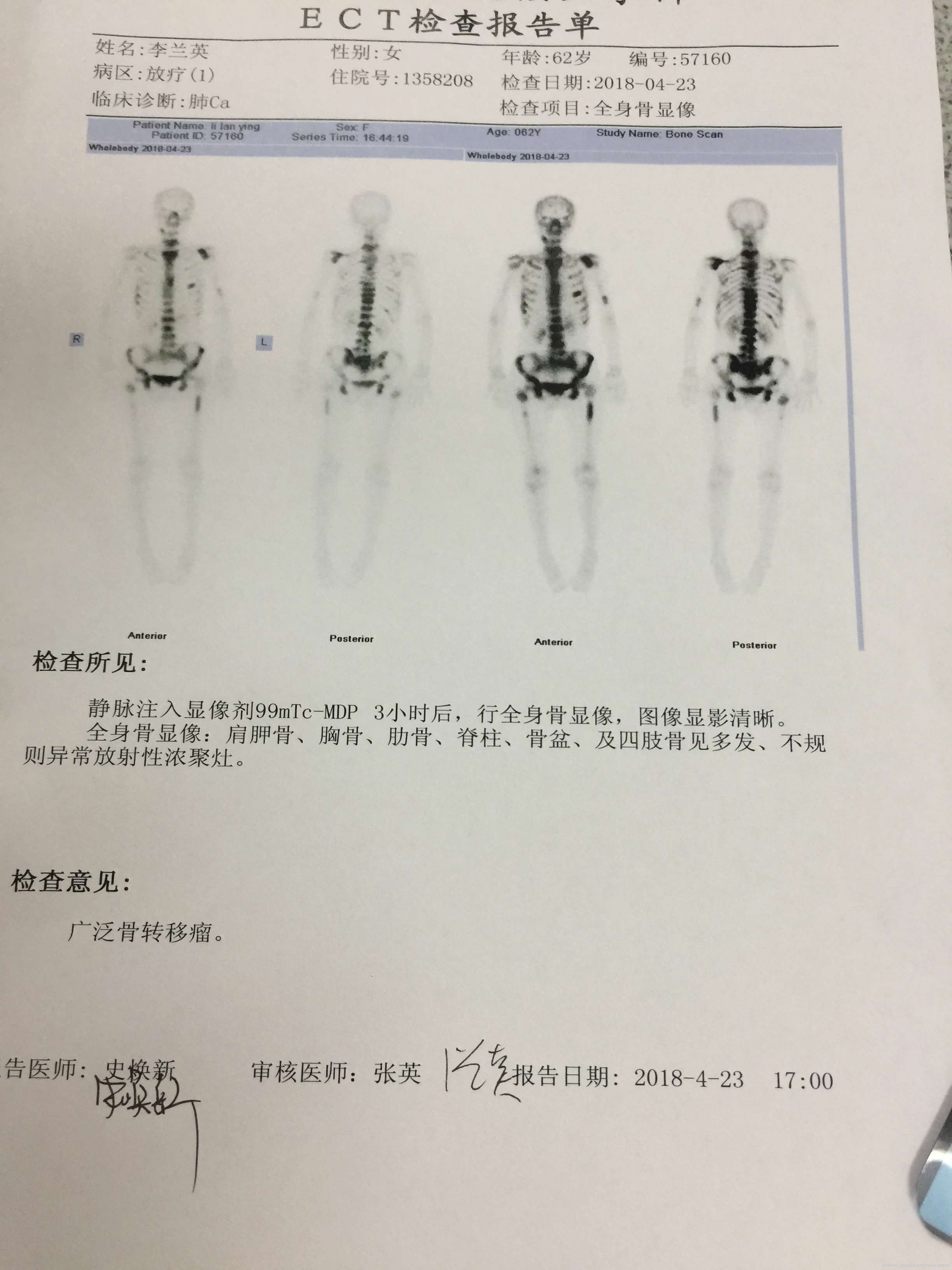 第二次骨扫描